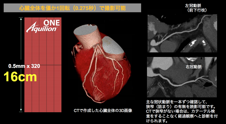 心臓全体をわずか1回転（0.275秒）で撮影可能　主な冠状動脈を一本ずつ確認して、狭窄（詰まり）の有無を読影可能です。CTで狭窄がない場合は、カテーテル検査をすることなく経過観察へと診断を付けられます。