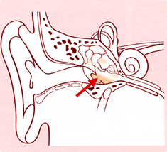 慢性中耳炎の図
